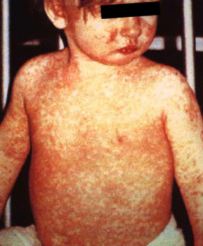 México continúa en estatus de eliminación del sarampión por un caso importado de un niño de Londres