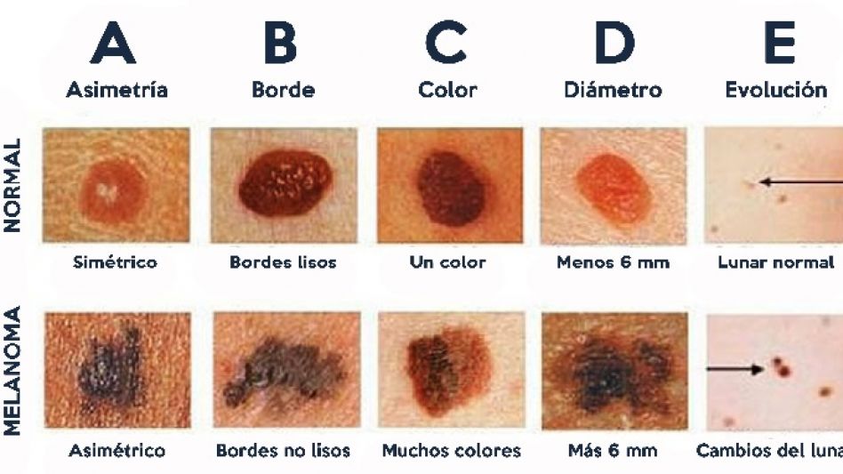 Lunares extraños, posible presencia de Melanoma