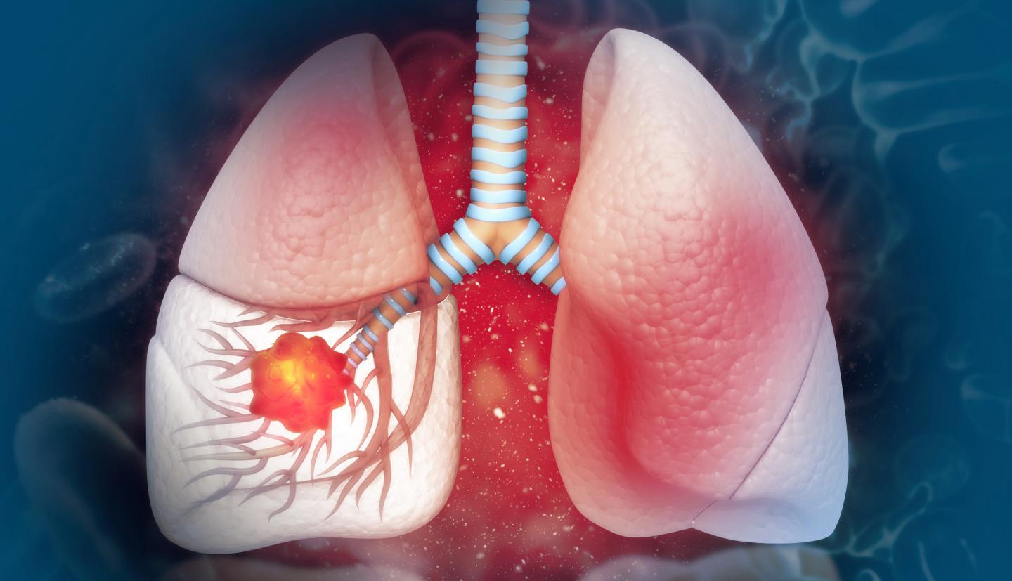 Cáncer de pulmón: el enemigo silencioso que afecta a miles de mexicanos