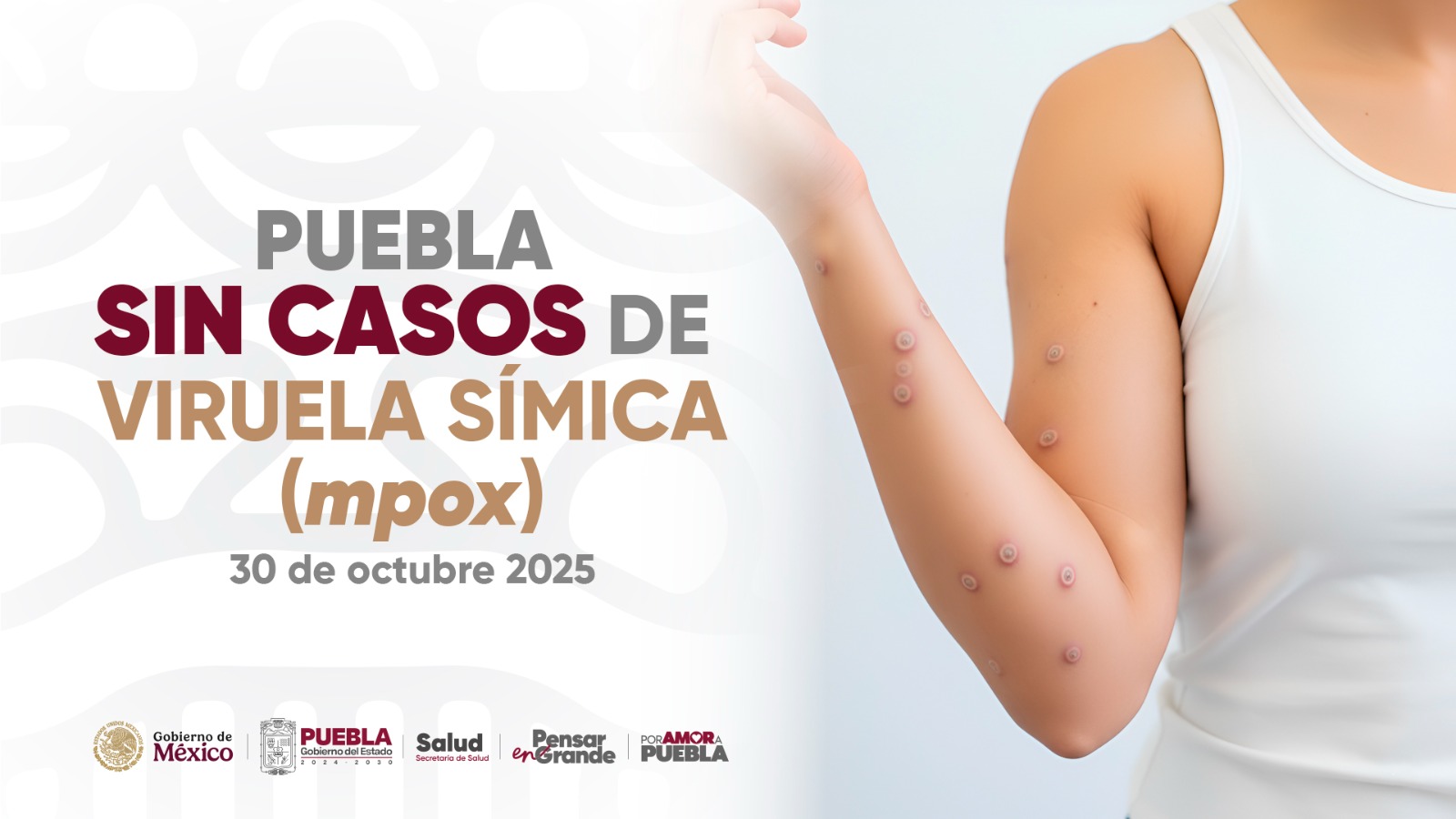 Salud Pública de Puebla aclara confusión sobre viruela símica en escuelas